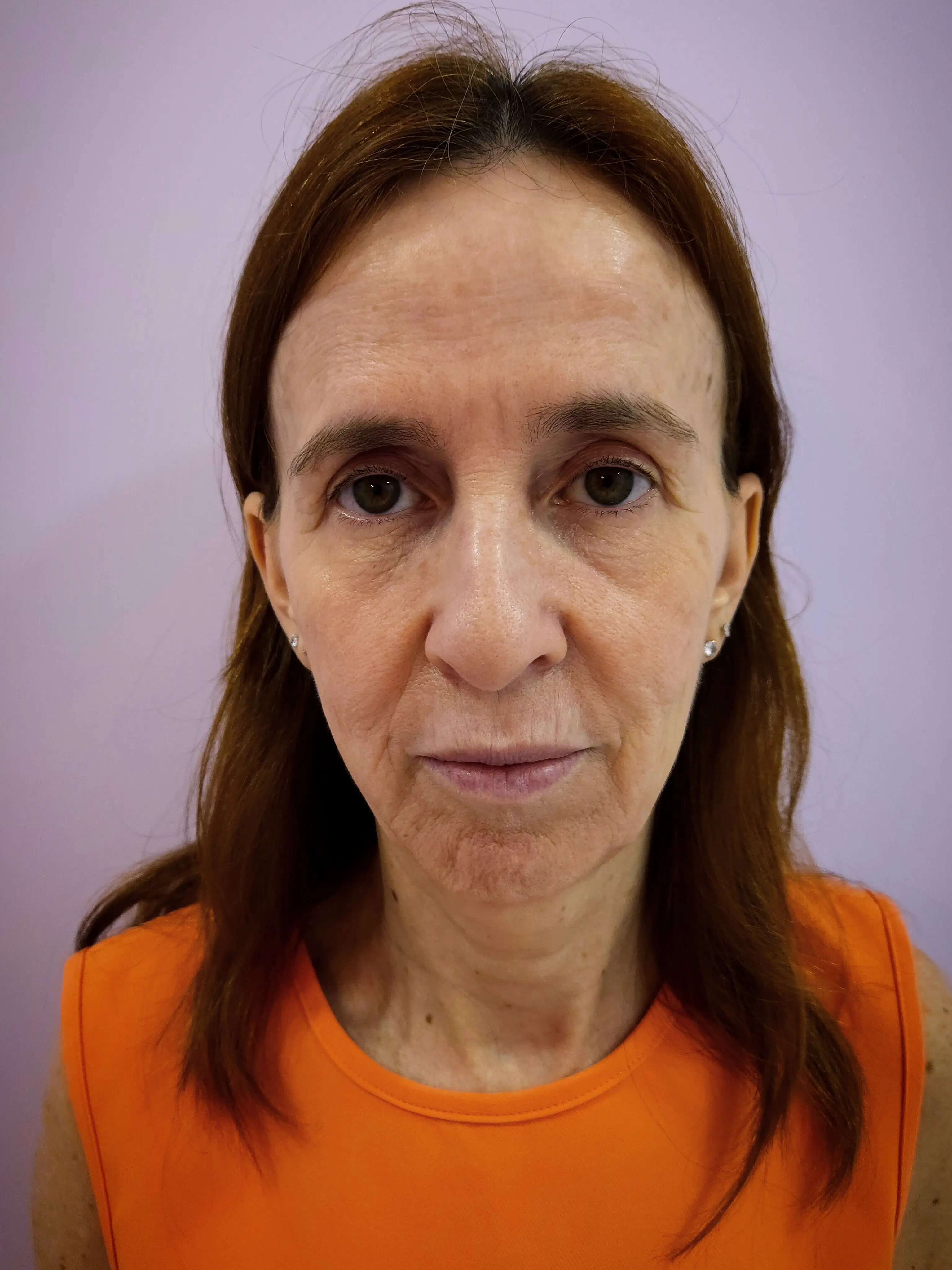 Antes do tratamento Radiance Plus