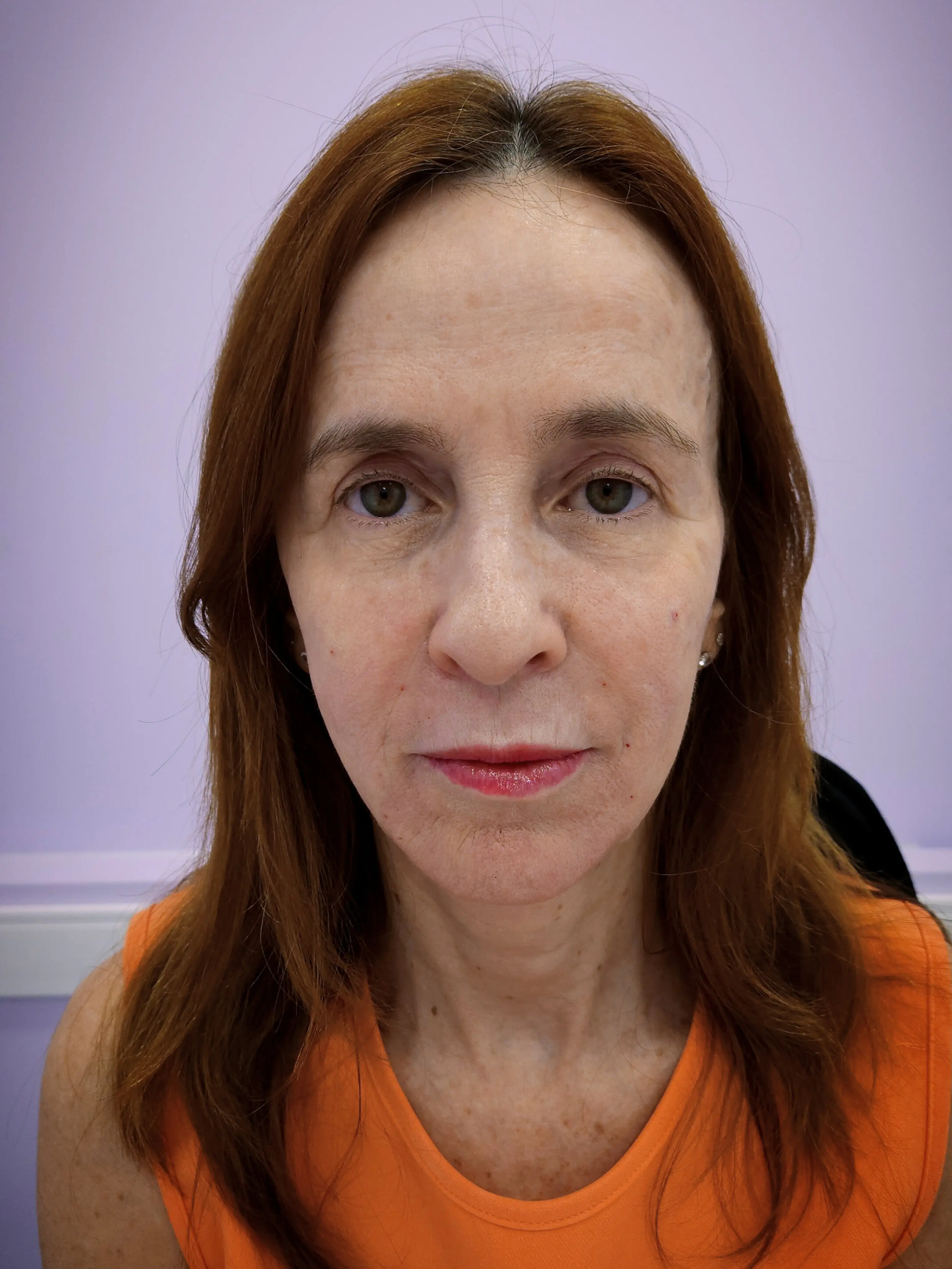 Depois do tratamento Radiance Plus